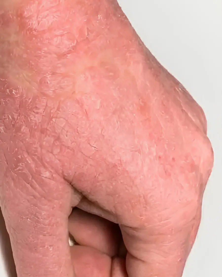 Eczema at Cinch Clinics